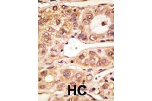 Formalin-fixed and paraffin-embedded human hepatocellular carcinoma tissue reacted with Tlr5 polyclonal antibody  , which was peroxidase-conjugated to the secondary antibody, followed by AEC staining. (TLR5 抗体  (C-Term))