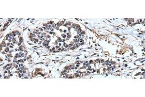 Immunohistochemistry of paraffin-embedded Human esophagus cancer tissue using PRUNE Polyclonal Antibody at dilution of 1:40(x200)