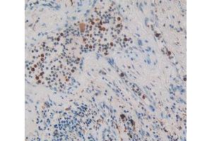 IHC-P analysis of lung cancer tissue, with DAB staining. (NUP153 抗体  (AA 1238-1468))