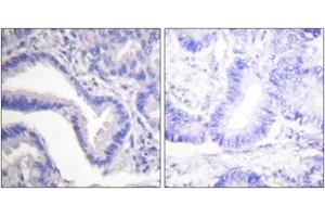 Immunohistochemistry analysis of paraffin-embedded human lung carcinoma tissue, using Caspase 7 (Cleaved-Asp198) Antibody. (Caspase 7 抗体  (Cleaved-Asp198))