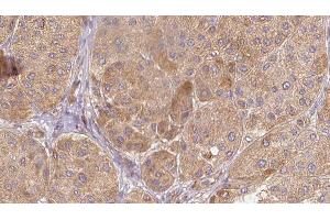 ABIN6277611 at 1/100 staining Human Melanoma tissue by IHC-P. (SEMG1 抗体  (C-Term))