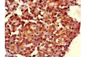 Immunohistochemistry of paraffin-embedded human breast cancer using ABIN7167597 at dilution of 1:100