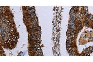 Immunohistochemistry of paraffin-embedded Human colon cancer using HMGCL Polyclonal Antibody at dilution of 1:30 (HMGCL 抗体)