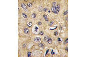 Formalin-fixed and paraffin-embedded human hepatocarcinoma tissue reacted with TSC2 Antibody  (ABIN390324 and ABIN2840755) , which was peroxidase-conjugated to the secondary antibody, followed by DAB staining. (Tuberin 抗体  (AA 1776-1805))