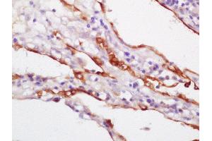 Formalin-fixed and paraffin embedded human lung carcinoma labeled with Rabbit Anti-CK18 Polyclonal Antibody,Unconjugated  at 1:200 followed by conjugation to the secondary antibody and DAB staining (Cytokeratin 18 抗体  (AA 301-423))