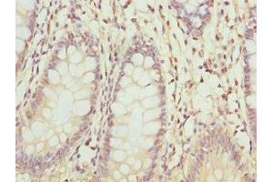 Immunohistochemistry of paraffin-embedded human colon cancer using ABIN7176363 at dilution of 1:100 (ZNF544 抗体  (AA 1-230))