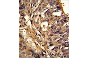 Formalin-fixed and paraffin-embedded human lung carcinoma reacted with ETFDH Antibody (N-term), which was peroxidase-conjugated to the secondary antibody, followed by DAB staining. (ETFDH 抗体  (N-Term))