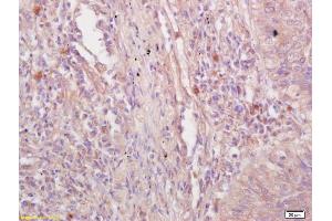 Formalin-fixed and paraffin embedded human lung carcinoma labeled with Rabbit Anti VE Cadherin/VECD/CD144 Polyclonal Antibody, Unconjugated (ABIN1387250) at 1:200 followed by conjugation to the secondary antibody and DAB staining (Cadherin 5 抗体  (AA 251-320))