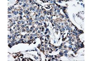 Immunohistochemical staining of paraffin-embedded Adenocarcinoma of breast tissue using anti-ATP5B mouse monoclonal antibody. (ATP5B 抗体)