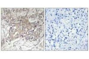 Immunohistochemistry analysis of paraffin-embedded human liver carcinoma tissue using GCNT3 antibody. (GCNT3 抗体)