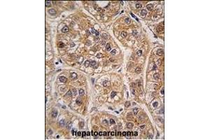 Formalin-fixed and paraffin-embedded human hepatocarcinoma tissue reacted with AKR1A1 antibody (C-term) (ABIN389204 and ABIN2837921) , which was peroxidase-conjugated to the secondary antibody, followed by DAB staining.