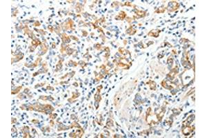 The image on the left is immunohistochemistry of paraffin-embedded Human gastric cancer tissue using (TEP1 Antibody) at dilution 1/40, on the right is treated with synthetic peptide. (TEP1 抗体)