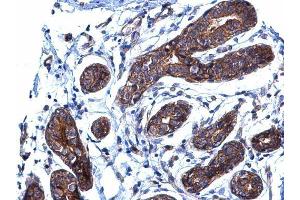 IHC-P Image BCAR1 antibody [N2C2], Internal detects BCAR1 protein at cytoplasm on human breast carcinoma by immunohistochemical analysis. (BCAR1 抗体  (Internal Region))