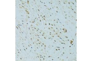 Immunohistochemistry of paraffin-embedded human uterine cancer using NHEJ1 antibody. (NHEJ1 抗体)