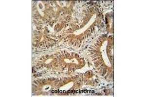 CCD antibody (C-term) (ABIN654259 and ABIN2844079) immunohistochemistry analysis in formalin fixed and paraffin embedded human colon carcinoma followed by peroxidase conjugation of the secondary antibody and DAB staining. (CEP89 抗体  (C-Term))