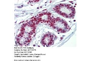 Rabbit Anti-FUS Antibody  Paraffin Embedded Tissue: Human Breast Antibody Concentration: 5 ug/ml (FUS 抗体  (N-Term))