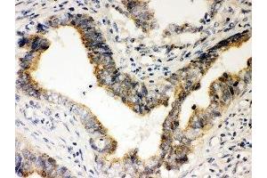IHC-P: Rad51 antibody testing of human intestine cancer tissue (RAD51 抗体  (AA 1-258))