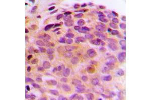 Immunohistochemical analysis of BAG4 staining in human breast cancer formalin fixed paraffin embedded tissue section. (BAG4 抗体  (C-Term))