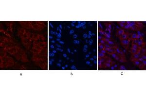 Immunofluorescence analysis of human stomach cancer tissue. (beta Catenin 抗体)