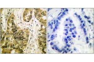 Immunohistochemistry analysis of paraffin-embedded human lung carcinoma tissue, using Galectin 3 Antibody. (Galectin 3 抗体  (AA 141-190))