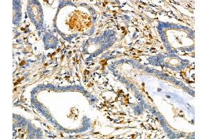 ABIN6261639 and ABIN6276641 at 1/100 staining Human gastric cancer by IHC-P.