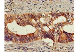 Immunohistochemistry of paraffin-embedded human colon cancer using ABIN7161673 at dilution of 1:100 (Olfactomedin 1 抗体  (AA 374-441))