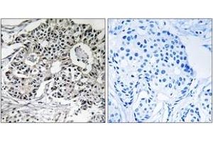 Immunohistochemistry analysis of paraffin-embedded human breast carcinoma, using PXMP2 Antibody. (PXMP2 抗体  (AA 38-87))