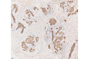 IHC analysis of Cytokeratin 19 using anti-Cytokeratin 19 antibody (ABIN3043288). (Cytokeratin 19 抗体  (C-Term))