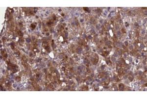 ABIN6276896 at 1/100 staining Human liver cancer tissue by IHC-P. (SLC22A6 抗体  (C-Term))
