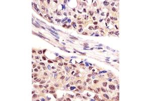 Antibody staining UCHL1 in human lung adenocarcinoma tissue sections by Immunohistochemistry (IHC-P - paraformaldehyde-fixed, paraffin-embedded sections). (UCHL1 抗体  (C-Term))