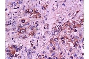 Formalin-fixed and paraffin embedded human gastric carcinoma tissue labeled with Anti-E-Selectin Polyclonal Antibody, Unconjugated (ABIN674244) at 1:200 followed by conjugation to the secondary antibody and DAB staining (Selectin E/CD62e 抗体  (AA 501-612))
