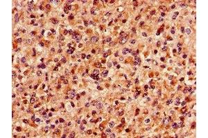 Immunohistochemistry of paraffin-embedded human glioma using ABIN7159758 at dilution of 1:100 (MAP4 抗体  (AA 575-818))
