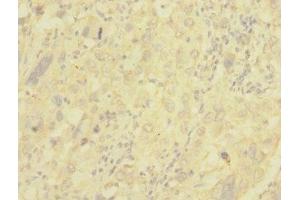 Immunohistochemistry of paraffin-embedded human liver cancer using ABIN7147644 at dilution of 1:100 (NG2 抗体  (AA 1950-2210))