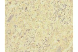 Immunohistochemistry of paraffin-embedded human liver cancer using ABIN7147644 at dilution of 1:100 (NG2 抗体  (AA 1950-2210))