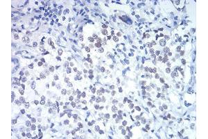 Immunohistochemical analysis of paraffin-embedded bladder cancer tissues using DDX5 mouse mAb with DAB staining. (DDX5 抗体  (AA 475-614))