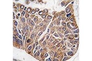 IHC analysis of FFPE human lung carcinoma tissue stained with AKT2 antibody