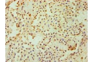 Immunohistochemistry of paraffin-embedded human breast cancer using ABIN7149890 at dilution of 1:100 (DKK4 抗体  (AA 19-224))