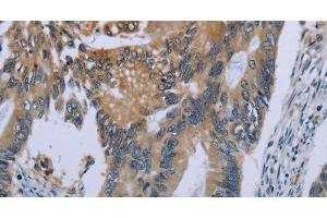 Immunohistochemistry of paraffin-embedded Human colon cancer using CEBPD Polyclonal Antibody at dilution of 1:40 (CEBPD 抗体)