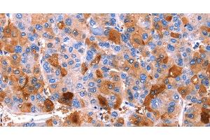 Immunohistochemistry of paraffin-embedded Human liver cancer tissue using ERN2 Polyclonal Antibody at dilution 1:40 (ERN2 抗体)
