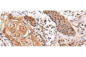 Immunohistochemistry of paraffin-embedded Human esophagus cancer tissue using ITPR2 Polyclonal Antibody at dilution of 1:65(x200) (ITPR2 抗体)