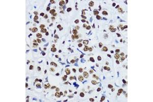 Immunohistochemistry of paraffin-embedded human mammary cancer using Acetyl-Histone H3-K9 antibody (ABIN7267675) at dilution of 1:200 (40x lens).