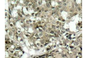 Immunohistochemistry analyzes of c-Abl antibody in paraffin-embedded human breast carcinoma tissue. (ABL1 抗体)