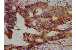 IHC image of ABIN7147529 diluted at 1:800 and staining in paraffin-embedded human colon cancer performed on a Leica BondTM system. (CHMP5 抗体  (AA 1-219))