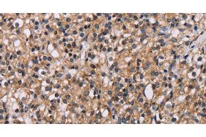 Immunohistochemistry of paraffin-embedded Human prostate cancer using GNL3 Polyclonal Antibody at dilution of 1:60 (Nucleostemin 抗体)