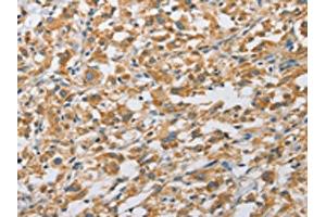 The image on the left is immunohistochemistry of paraffin-embedded Human thyroid cancer tissue using ABIN7128493(ARHGAP5 Antibody) at dilution 1/25, on the right is treated with fusion protein. (ARHGAP5 抗体)