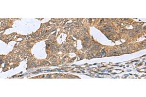Immunohistochemistry of paraffin-embedded Human colorectal cancer tissue using RPL18 Polyclonal Antibody at dilution of 1:70(x200) (RPL18 抗体)