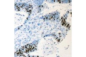 Immunohistochemical analysis of Cyclin C staining in human colon cancer formalin fixed paraffin embedded tissue section. (Cyclin C 抗体)
