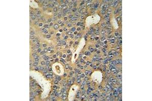 Immunohistochemistry analysis in human prostate carcinoma (formalin-fixed, paraffin-embedded) using MICAL-like protein 1 Antibody (C-term), followed by peroxidase conjugation of the secondary antibody and DAB staining. (MICAL-Like 1 抗体  (C-Term))