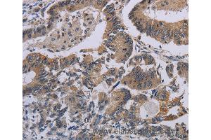 Immunohistochemistry of Human cervical cancer using CCL1 Polyclonal Antibody at dilution of 1:50