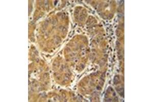 Immunohistochemistry analysis in formalin fixed and paraffin embedded human hepatocarcinoma reacted with MCEE Antibody (C-term) followed which peroxidase conjugated to the secondary antibody and followed by  DAB staining. (MCEE 抗体  (C-Term))